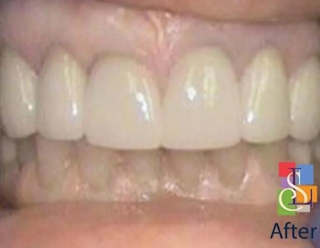 Porcelain Crowns Case 2 after Porcelain Crowns Case 2 after