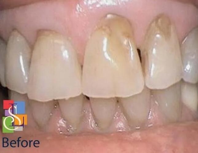Porcelain Crowns Case 2 before Porcelain Crowns Case 2 before