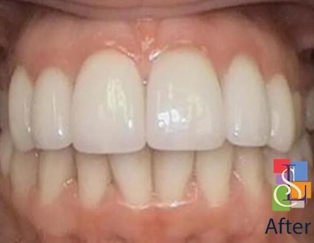Porcelain Crowns Case 3 after Porcelain Crowns Case 3 after