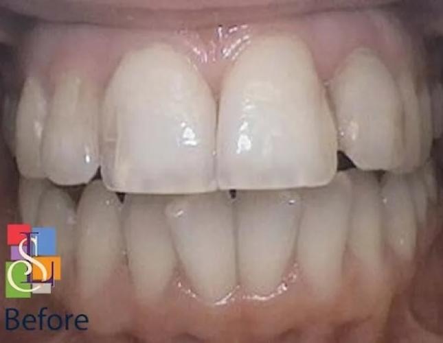 Porcelain Crowns Case 3 before Porcelain Crowns Case 3 before
