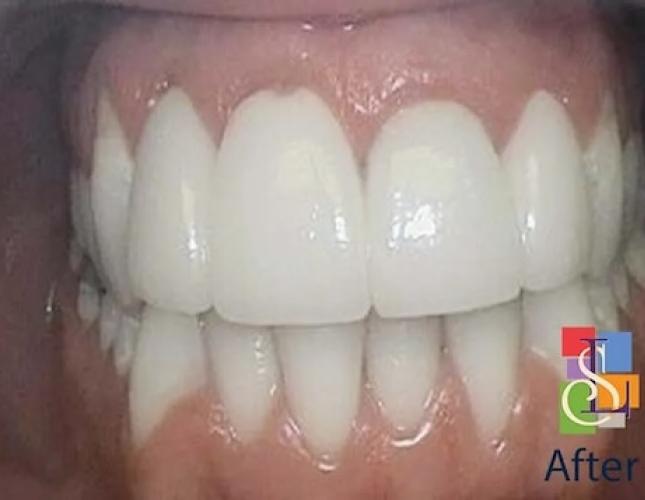 Crowns and KOR whitening after Crowns and KOR whitening after