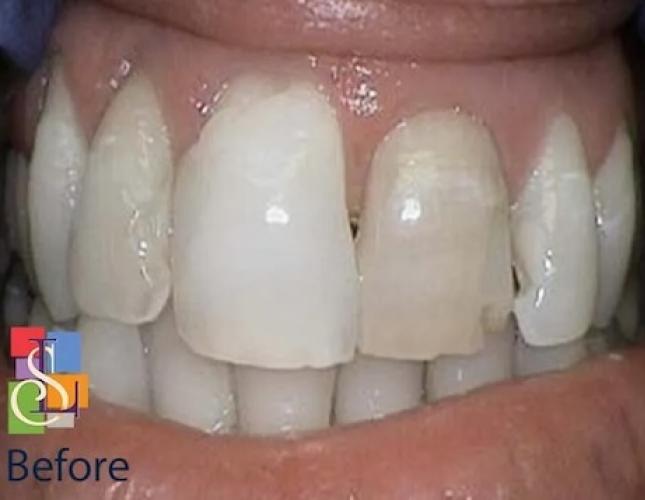 Crowns and KOR whitening before Crowns and KOR whitening before