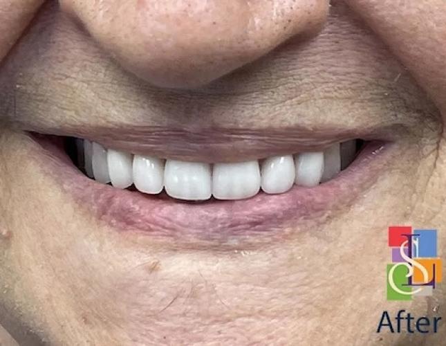 Dentures after Dentures after