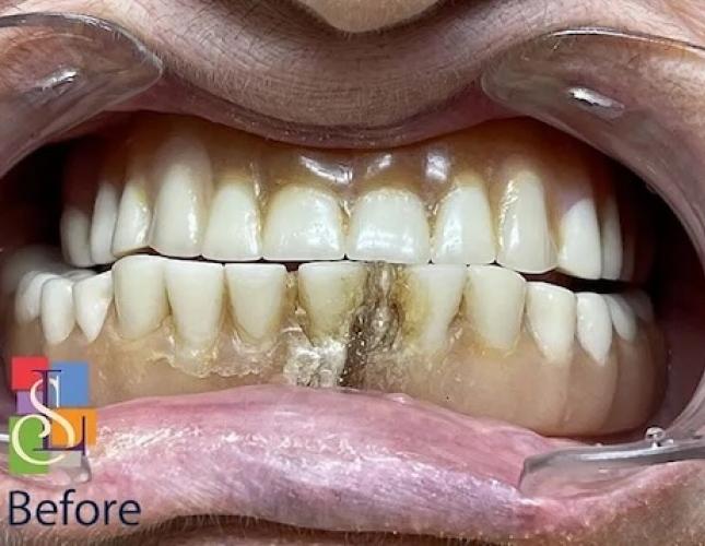 Dentures before Dentures before