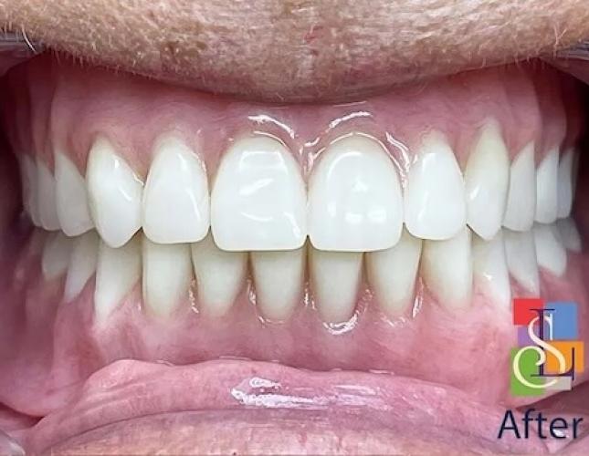 Implants after Implants after