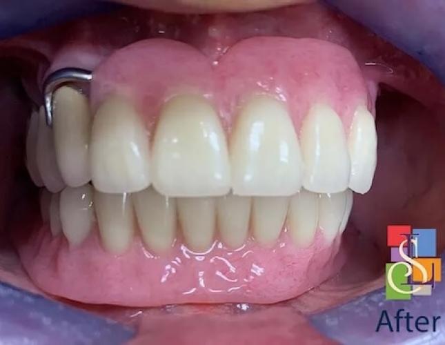 Implant Supported Dentures after Implant Supported Dentures after