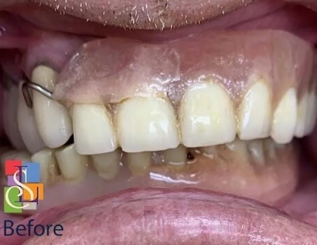 Implant Supported Dentures before Implant Supported Dentures before