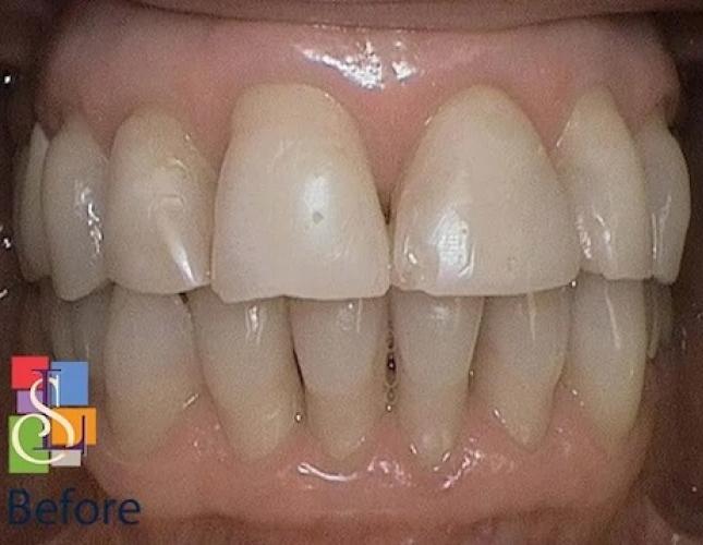 Porcelain Crowns Case 1 before