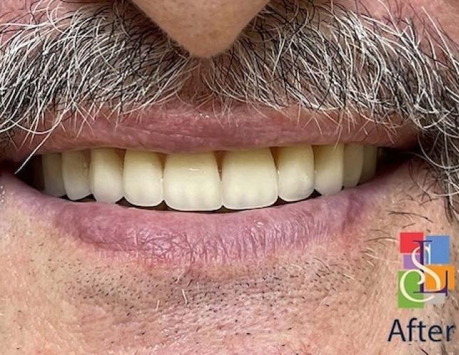 Upper Dentures after Upper Dentures after