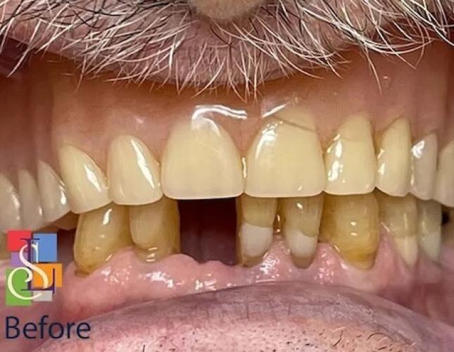 Upper Dentures before Upper Dentures before