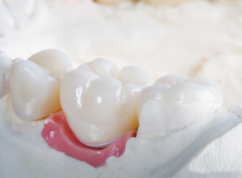 Caring for Your Dental Crown: Tips for Longevity and Oral Health