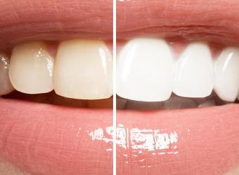 The 3 Best Cosmetic Dental Procedures for a White Smile