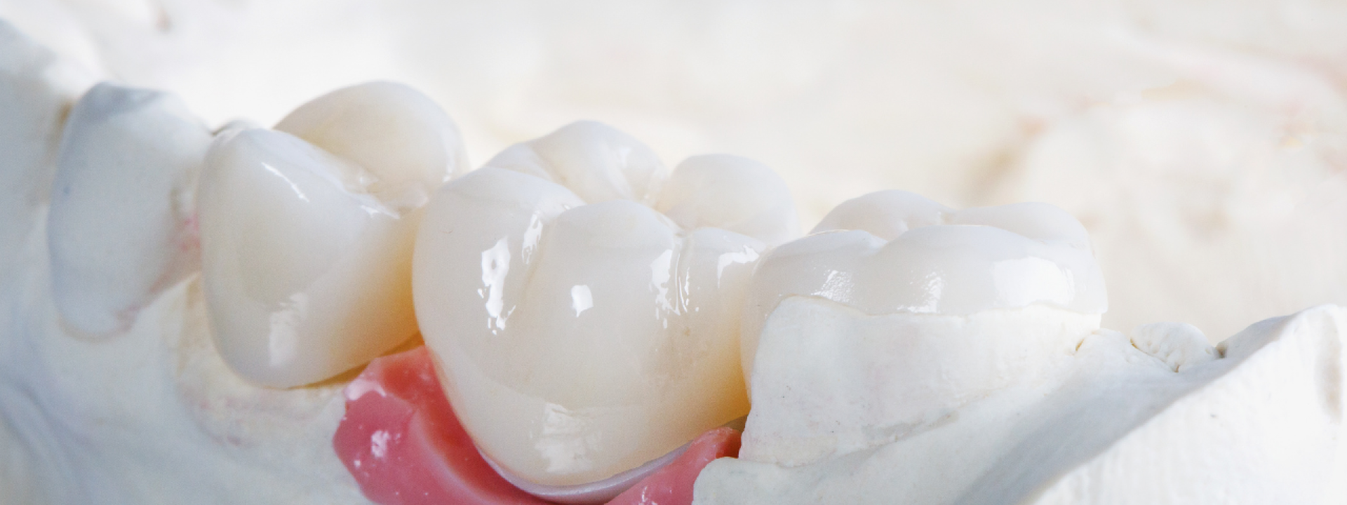 Dental Crown