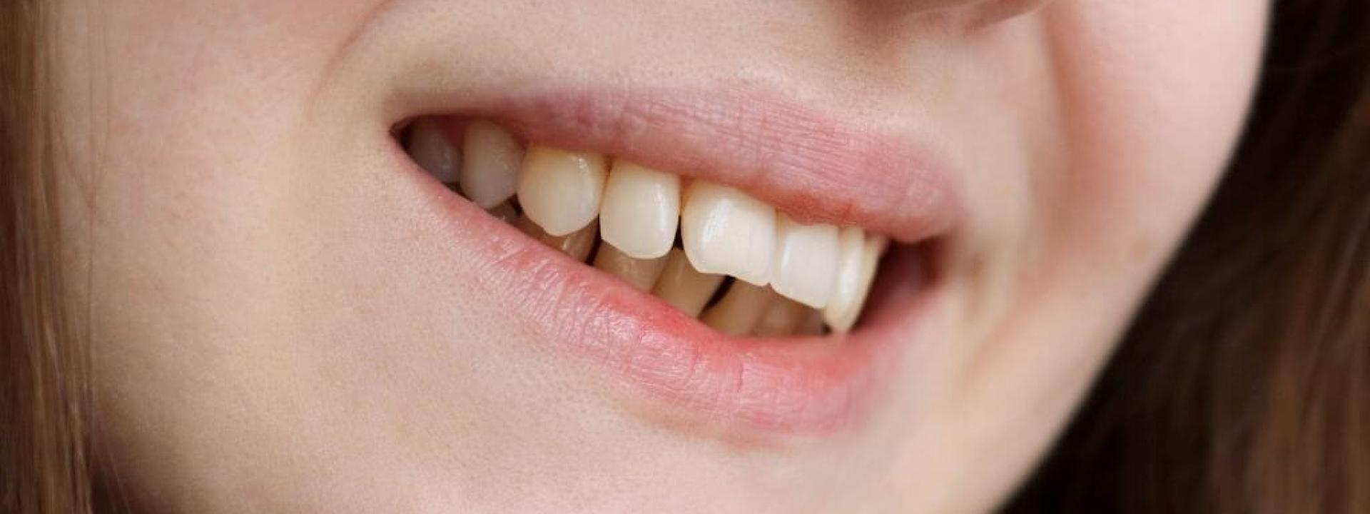 Woman with malocclusion bite alignment issues